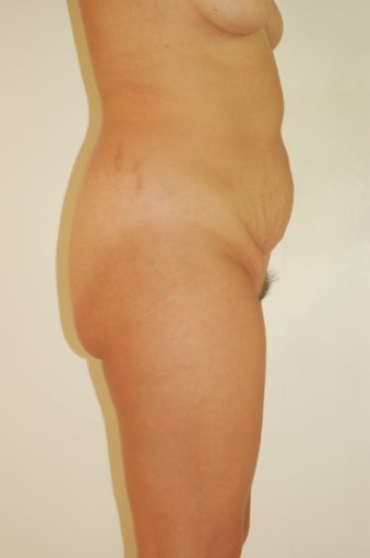 Buttock Enhancement