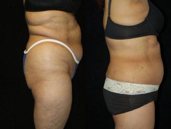 66 Year-Old Woman Treated for Bulky Fat of Bra Rolls, Flanks, and Waist