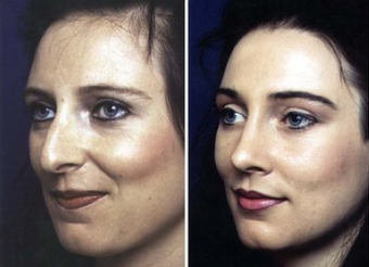Rhinoplasty