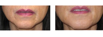 Juvederm/Fat Grafting