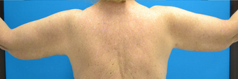 SmartLipo Before & After