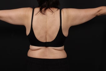 56 year old female, bra line back lift