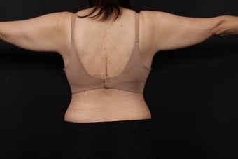 56 year old female, bra line back lift