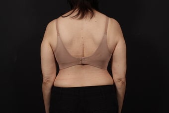 56 year old female, bra line back lift
