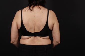 56 year old female, bra line back lift