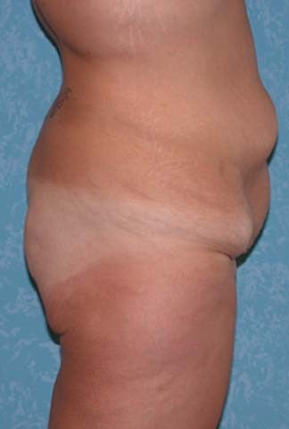 Circumferential Body Lift with Buttock Augmentation