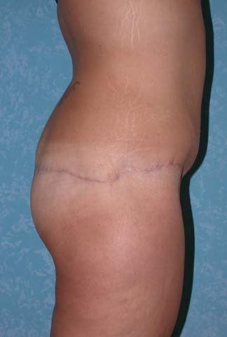 Circumferential Body Lift with Buttock Augmentation