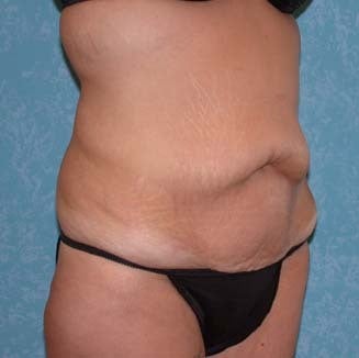 Circumferential Body Lift with Buttock Augmentation