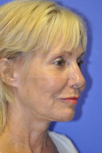 Woman, laser resurfacing procedure