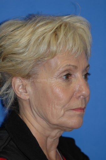 Woman, laser resurfacing procedure