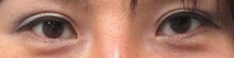 Revision Bilateral Asian Eyelid Surgery