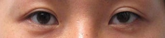 Revision Bilateral Asian Eyelid Surgery