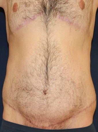 Male Body Lift