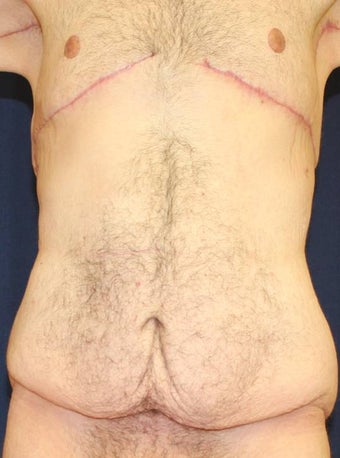 Male Body Lift