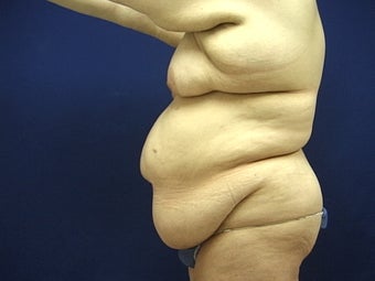 Lower body lift following massive weight loss