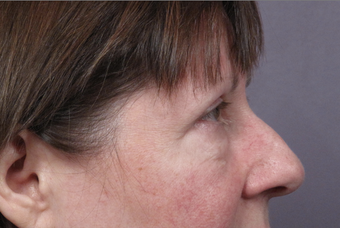 Eyelid Surgery