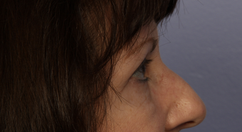 Eyelid Surgery