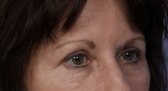 Eyelid Surgery
