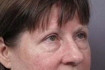 Eyelid Surgery