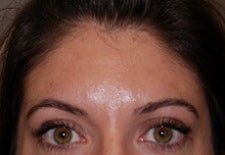 Botox to glabella