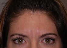 Botox to glabella