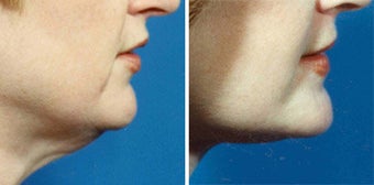 Lower Facelift