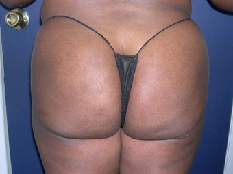 Buttock Augmentation