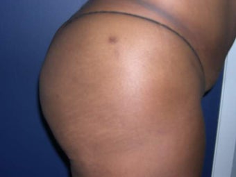 Buttock Augmentation