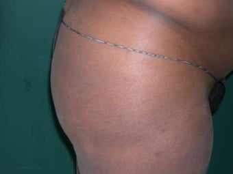 Buttock Augmentation