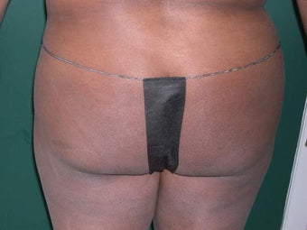 Buttock Augmentation