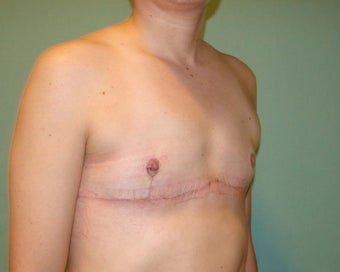 FTM "Top Surgery"