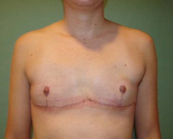 FTM "Top Surgery"