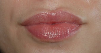 Lip Augmentation