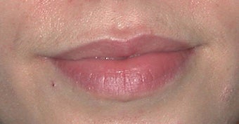 Lip Augmentation