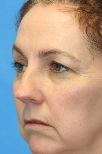Browlift w hairline lowering, Upper eye blepharoplasty, Lower eyelid skin pinch, Fat transfer