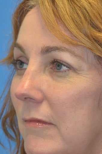 Browlift w hairline lowering, Upper eye blepharoplasty, Lower eyelid skin pinch, Fat transfer