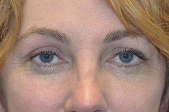 Browlift w hairline lowering, Upper eye blepharoplasty, Lower eyelid skin pinch, Fat transfer