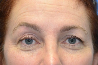 Browlift w hairline lowering, Upper eye blepharoplasty, Lower eyelid skin pinch, Fat transfer