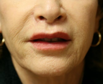 Lip Lift