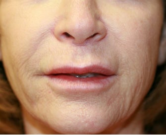 Lip Lift