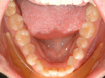 Invisalign treatment for crowded teeth with a cross-bite 