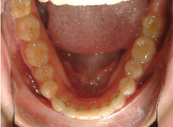 Invisalign treatment for crowded teeth with a cross-bite 