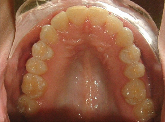 Invisalign treatment for crowded teeth with a cross-bite 