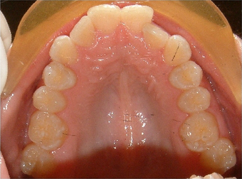Invisalign treatment for crowded teeth with a cross-bite 