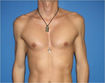 Pectoral Augmentation, Pec Implants