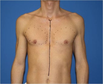 Pectoral Augmentation, Pec Implants