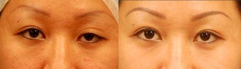 Asian Eyelid Surgery for Ptosis