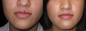 Mole removal using plastic surgery techniques