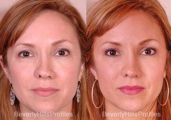 Revision Rhinoplasty