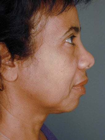 Female Chin Implant 